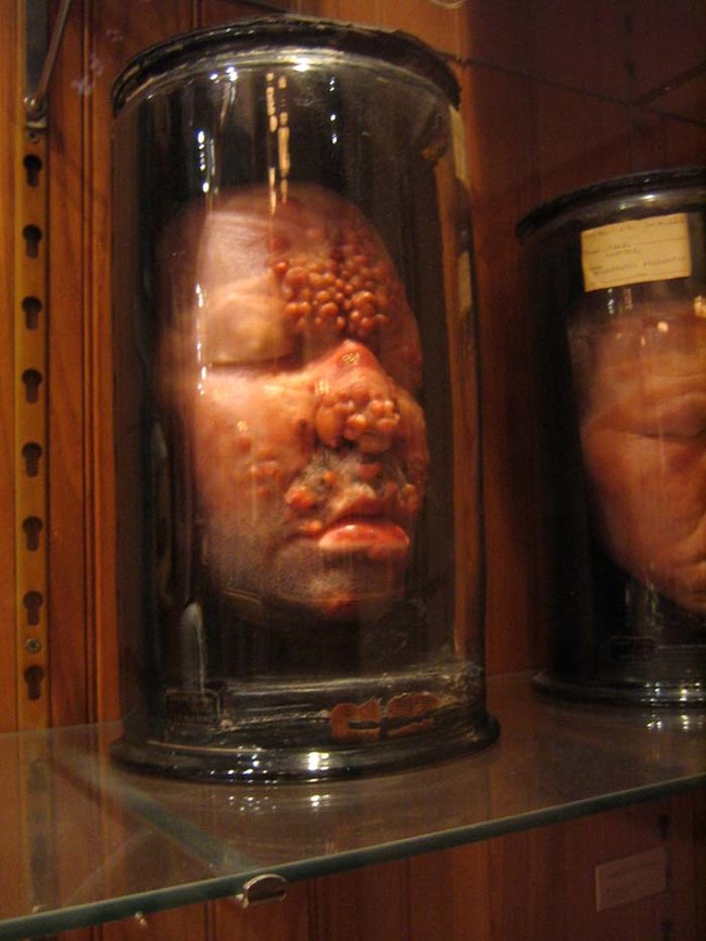 Aside from its actual medical specimens, the Mütter Museum is home to many wax models. They demonstrate the stages of different diseases.