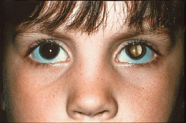 retinoblastoma eye