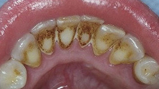 14 disgusting pairs of teeth