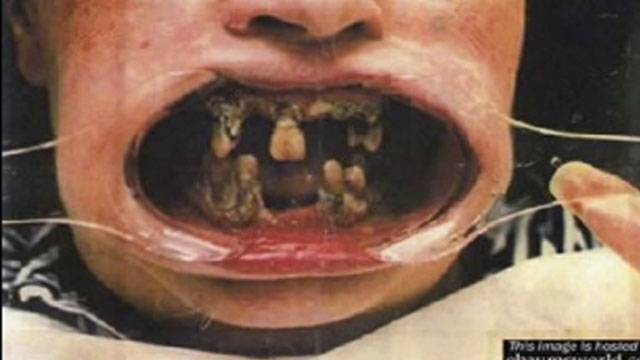 14 disgusting pairs of teeth