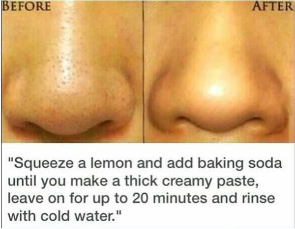 get rid of pimples in minutes - Before After "Squeeze a lemon and add baking soda until you make a thick creamy paste, leave on for up to 20 minutes and rinse with cold water."