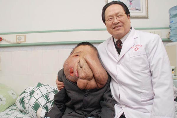 Huang Chuncai was known as the "Elephant Man of China," due to a massive growth on his face that was so huge it went down to his waist. Also nicknamed as the “man with the melting face,” Chuncai's 56-pound tumor was so large that he had to hold it every time he went for a walk.

The 37-year-old had the worst case of neurofibromatosis ever recorded. He could barely move, eat or sleep due to his condition. Chuncai got progressively worse over time, and his face looked like it was literally melting. The neurofibromatosis also stunted his growth—Huang grew to only 4ft tall as the pressure of the weight on his spine gave him a hunchback. The condition was left untreated for 30 years, as his parents could not afford surgery.

Chuncai became despondent and considered suicide after his parents were offered money for him to star in a freak show. At his darkest hour, he was finally given the chance for a normal life when the Chinese government offered to finance the surgery to remove the growths. 

At first, doctors at the Fuda Cancer Hospital weren't sure they could help Chuncai. The chief physician, Wu Binghui, said, "I was shocked, I had never seen a tumor as big as Haung's on a human body. The tumor was full of blood. It would flow out when you cut it.”

After four operations over seven years, doctors removed over 46 pounds of the tumor. Chuncai said, "I feel really good, my face feels even better—much lighter and it's easier to eat.” He is now looking forward to his future and told the press, “I hope I can earn some money. I don't look as scary as (I did) before, now (that) my tumor is much smaller.”