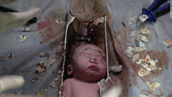 This poor baby got stuck in the pipes of an apartment building in Jinhua, China. Rescuers had to saw away the entire pipe to free the infant, who was brought to the hospital and listed in stable condition. The 22-year-old mother said she gave birth over the toilet, but did not mean to flush away the baby—she merely wanted to clear away the blood. Authorities believed her and the child was returned.