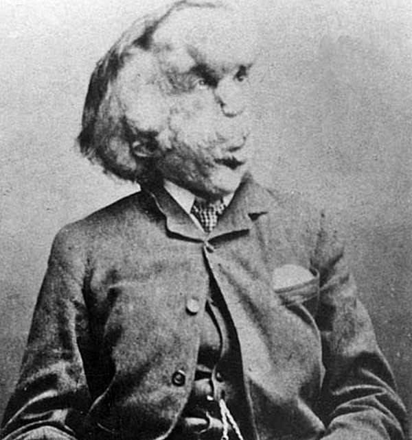 The majority of the public viewed Joseph Merrick as nothing less than a monster. They couldn't have been more wrong. Those who knew Merrick spoke of him as being quite a gentle soul, and though his condition often made it hard for him to be understood, he was highly intelligent. 

Once Merrick stopped touring and was no longer able to fend for himself, he spent the remainder of his life in a customized hospital ward. It was a terribly lonely existence, but from time to time he would receive gifts and visits from actresses such as Marge Kendal and even the Princess of Wales.

Throughout his life, Merrick longed to be treated like any other person. This has caused many to theorize that his wish for normalcy could've played a role in his death. It was a known fact that due to the weight of his head, he had to sleep sitting up in bed with his head tucked between his knees. On the morning of April 11, 1890, he was found dead laying on his back. Merrick attempted to sleep like a normal person, but the weight of his head became too much. For years, it was believed that he had died from the weight of his head somehow managing to crush his windpipe, but it was later determined that his death stemmed from a broken vertebrae. He died at the age of 27.