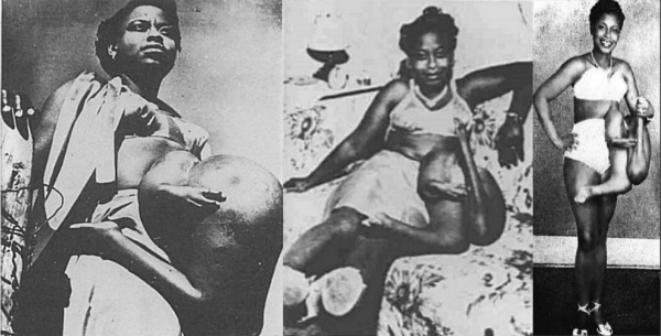 Betty Lou Williams was born poor in Georgia in 1932. She was the youngest of 12 children and the only one to be born with four legs and an extra arm—she was carrying a parasitic twin whose head was also lodged in her torso. 

As a toddler, Betty was placed on tour. She began making $250 a week by the age of two thanks to her unique aesthetics. As an adult, her salary quadrupled, amounting to over $1,000 a week. Her choice of career had not only earned her enough to put all of her siblings through college, but she was also able to purchase a home for her parents in their later years.

If it's not already evident, Williams had a generous heart. She was considered a great beauty and her deformity never got in the way of her many admirers. By the age of 23, she fell madly in love and was engaged. Although Williams was in the relationship for love, she soon learned that the intentions of her fiancé weren't as pure. To him, Betty was nothing more than an easy payday. He eventually took her life savings and skipped town. His actions became more than Betty could bare—the betrayal had not only taken a toll on her emotionally but ultimately led a full-blown asthma attack. Though suffocation was documented as the cause of death, those who knew her best were adamant that she'd died of a broken heart.