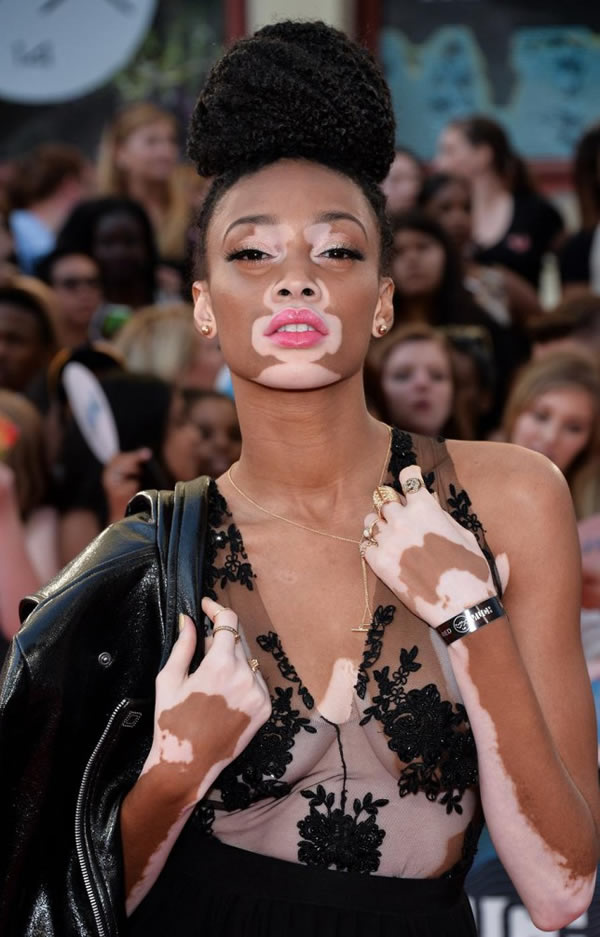 19-year-old Canadian model Winnie Harlow (real name Chantelle Young-Brown) is the star of two major spring/summer fashion campaigns.

A sufferer of vitiligo, a skin pigment disorder, Winnie is changing the fashion industry one campaign at a time. In 2015, she was unveiled as the face of Spanish brand Desigual's spring/summer campaign entitled "Say Something Nice" and has been confirmed as their official brand ambassador. She also stars in Diesel's SS15 ads, which aim to promote "tolerance, equality, and unconditional love."

Diagnosed with vitiligo around the age of four, she was bullied and called "zebra" and "cow" because of the white patches on her face and body. She's since become a spokesperson for vitiligo—the same condition that is believed to have affected Michael Jackson—and has over 430,000 followers on Instagram.