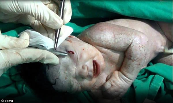 Medics in Syria performed an emergency caesarean on a woman whose unborn baby was injured in a missile strike in Aleppo.

An incredible video captures the moment doctors pull the baby girl from her mother's womb with a piece of shrapnel implanted in her tiny brow. Medics frantically work to revive her, rigorously rubbing her limp body and clearing her airways, until she could take her first breath.

The healthcare workers from Aleppo City Medical Council (a non-profit medical service in the city) can be heard rejoicing when the newborn makes her first whimpers minutes later. She then breaks out into a full cry after they successfully remove the debris from her head, leaving a finger-sized wound. Both mother and baby are said to be recovering and are doing great!