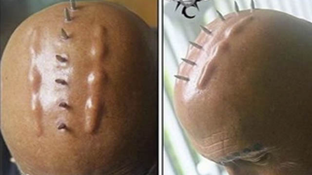 15 Bizarre Body Implants That Will Make You Cringe
