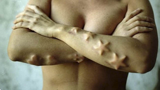 15 Bizarre Body Implants That Will Make You Cringe