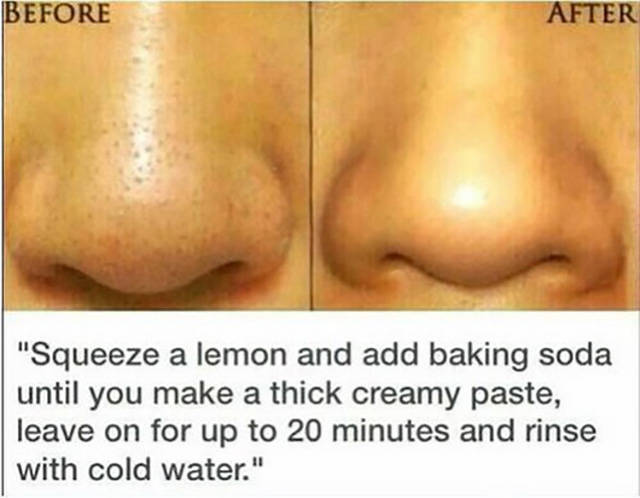 pesky pores - Before After "Squeeze a lemon and add baking soda until you make a thick creamy paste, leave on for up to 20 minutes and rinse with cold water."