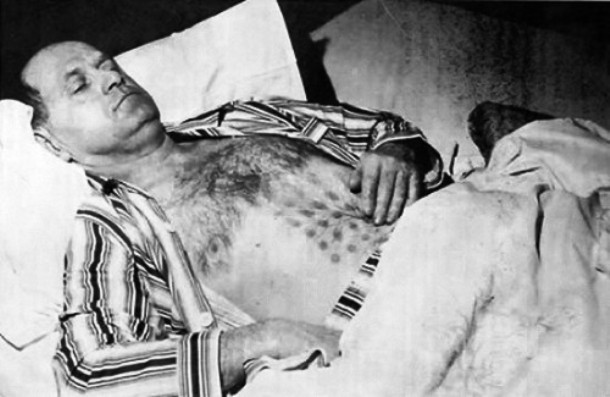 In 1967, Stefan Michalak reportedly encountered an unidentified flying object near Falcon Lake, Canada. Michalak was close enough to touch the object but then, it suddenly lifted off, knocking him on his back. Michalak claimed to have been burnt by the object´s exhaust vent that was covered with a grid. The hot gases even left burn marks on his chest as it can be seen in the photo. After this bizarre accident, Michalak got very sick, suffering from symptoms typical of radiation but the nature of the burns has remained a mystery.