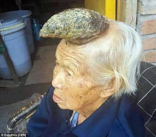 Chinese doctors are baffled by a bizarre, five-inch growth on an elderly woman's head. They aren't able to explain what it is exactly, but it bears an uncanny resemblance to a unicorn's horn! 

It all started when the "Unicorn Woman," Liang Xiuzhen, developed a mole on her head about seven or eight years ago. “My mother complained about this mole-like growth on her head that itched all the time,” said her son, Wang Chaojun. “We found ways to cure her itch using traditional Chinese medicine, and then let it be.” However, matters continued to get out of hand, when a tiny horn-like mass erupted from the mole two years ago. It remained small until February 2015 when Liang accidentally broke it. A new horn grew in its place and now measures a whopping five inches in length.

87-year-old Liang's photographs are now all over the internet, and doctors are clueless about what to do with her grotesque horn. Some have diagnosed it as a "cornu cutaneum"—a keratinous skin tumor that looks like a horn. Surgery is the only option to have it removed, but Wang Chaojun is skeptical.