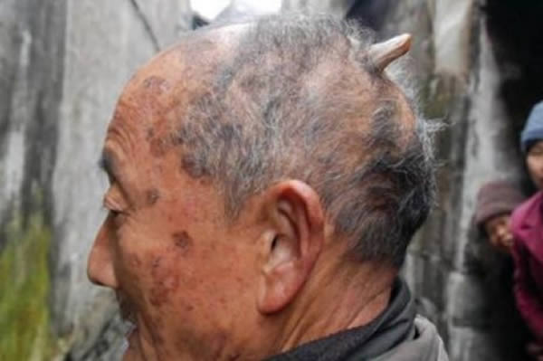 A man from Ziyuan, southern China has grown a bizarre horn on his head measuring three inches—and it's still growing.

Huang Yuanfan, 84, said the odd growth started two years ago as a small bump but continued to grow. He said, "I tried picking at it and even filing it, but nothing changed. The horn just kept getting bigger." Yuanfan says it has now reached three inches and is showing no signs of stopping. He added, "Doctors say they don't know what caused it but if they try to take it off it will just come back. I try to hide it beneath a hat but if it gets much longer, it will be sticking out the top."