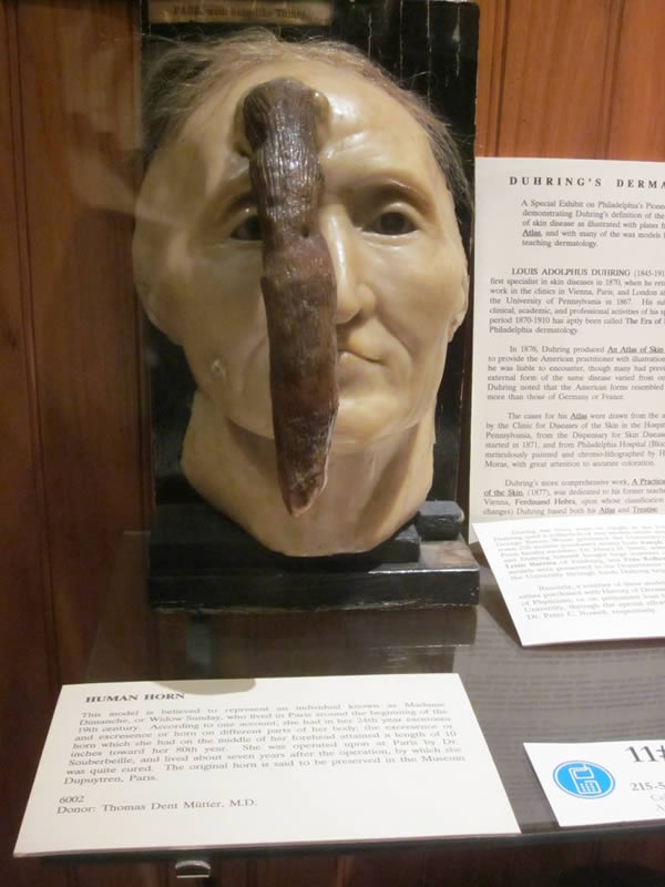Madame Dimanche, also known as Widow Sunday, was a French woman living in Paris in the early 19th century who grew a 24.9 cm (9.8") horn from her forehead before it was successfully removed by a French surgeon. A wax model of her head is on display at the Mütter Museum in The College of Physicians of Philadelphia.