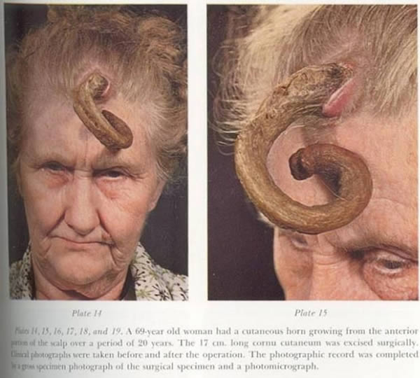 One of the most spectacular cases of human cutaneous horns involves the 69-year-old woman in the photos above. Though details on her case are sketchy, it is known that she tolerated the 17 cm long horn growing from the center of her forehead for approximately 20 years before having it surgically removed.

Over a period of two decades, the horn grew asymmetrically, eventually coiling around in the fashion of a ram's horn. Once the 17 cm (6.8 inches) horn was removed, the woman only needed a bit of light makeup to appear normal.