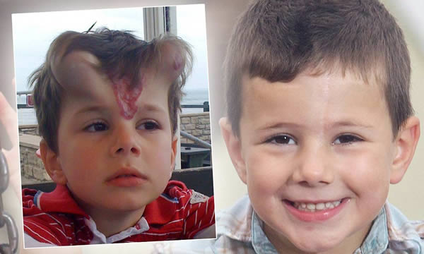 Doctors have treated a young boy with a large birthmark on his face—by implanting horns in his forehead. George Ashman, 5, was born with a bright red blemish on his forehead and his mother Karen, 33, feared he would endure a lifetime of bullying. When he was four, he underwent a surgical procedure to stretch the "normal" skin on his forehead so the birthmark could be removed and covered with the new unblemished tissue.

Doctors inserted two tissue expanders under the skin, which gradually inflated so they looked like two perfect devil's horns. After four months, the implants were removed, and the blemish was cut out, allowing the new skin to be stitched together, leaving just a small Harry Potter-style scar on George's forehead. 

During the time he had the horns, George was subjected to cruel taunts from passers-by.