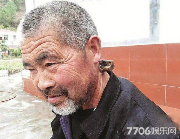 For over 30 years, a man in China has been living with a horn growing out of his neck. 62-year-old Li Zhibing, from Shiyan in Hubei Province, said that the unusual growth first appeared on his neck in 1980. Since then, the horn has been growing at an alarming pace, so Li's friends help him saw it off twice a year.

Li's greatest wish is to find out more about the mysterious horn and what caused it. He used to visit a local doctor who treated it with herbs from the nearby mountains. But Li now suspects that this treatment made the horn grow faster. At its longest, the horn has grown up to 15 centimeters perpendicularly from the nape of his neck. And when it gets too long, his neck gets swollen, and he runs a fever. So he needs to saw it off from time to time.