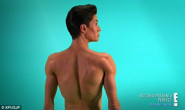 In May 2015, a man who has spent more than £150,000 on his quest to become a human Ken doll went under the knife to have "wings" implanted into his back. Justin Jedlica, who says he won't stop having surgery until he is "100% plastic," has had 190 operations, among them five nose jobs, shoulder implants, and a chin augmentation.

His latest operation involved having four implants, all self-designed, placed on his back in a bespoke procedure designed to "give the illusion of wings." The experimental procedure involved having one huge implant placed beneath the muscle on his back with further implants stacked on top of the muscle on both sides.

He also took the opportunity to have what he calls "Julia Roberts' veins" on his forehead dealt with in a dangerous procedure that could have left him blind.