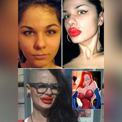 Recently, many women have taken drastic measures to look like the cartoon character Jessica Rabbit, but Kristina Rei was one of the first. She achieved the "sexy" look by inflating her lips with over 100 injections. She also has plans to get a breast augmentation to make her a DD. At least, in this case, her ribs are still intact.