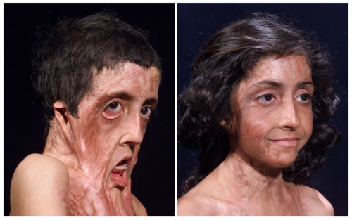 Burn Victim Before and After Facial Reconstruction