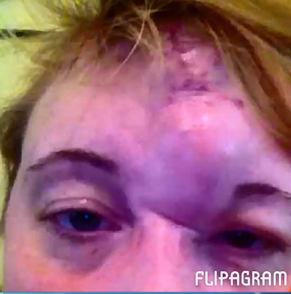 A mom was in for a shock after doctors told her what was under a birthmark which exploded during pregnancy. Mother-of-five Sam Davies had lived with the blemish on her forehead all her life. Despite being bullied about the mark by schoolmates who called her "the unicorn," she thought nothing more of it. However, after the blemish burst, the 31-year-old discovered there were THREE cancerous tumors underneath. 

Doctors carried out life-saving surgery that left part of her skull exposed. She later confirmed she isn't planning on having any more children “just in case the monster wakes up again."