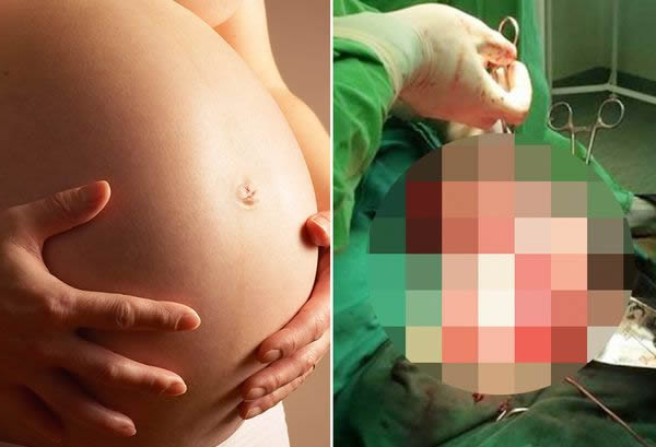 A woman who thought she was pregnant has been left devastated after her "baby bump" turned out to be an 11lb tumor. Heartbroken Madalina Neagu, 42, thought she was in labor when she arrived at the hospital with severe pain in her abdomen. After carrying out emergency tests, doctors from Botosani County Hospital in Romania were stunned to find a large tumor inside her uterus.

Neagu had complex emergency surgery lasting several hours to remove the tumor and she is expected to make a full recovery.