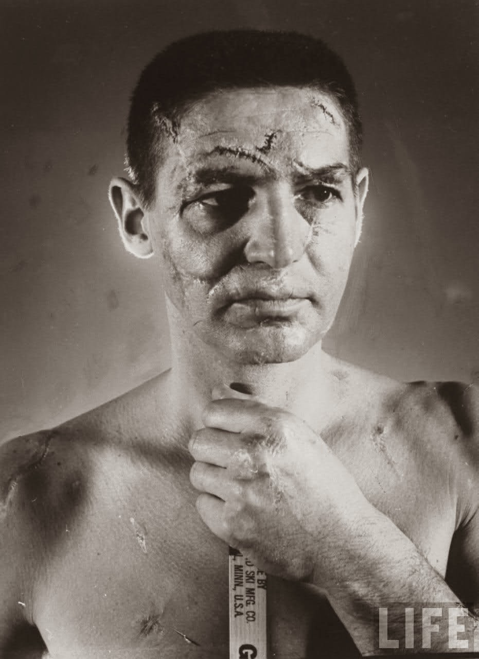 A picture of goalie Terry Sawchuk before hockey masks were a thing, 1966.