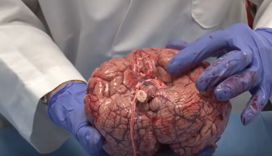 Anatomy Professor shows how delicate the human brain actually is