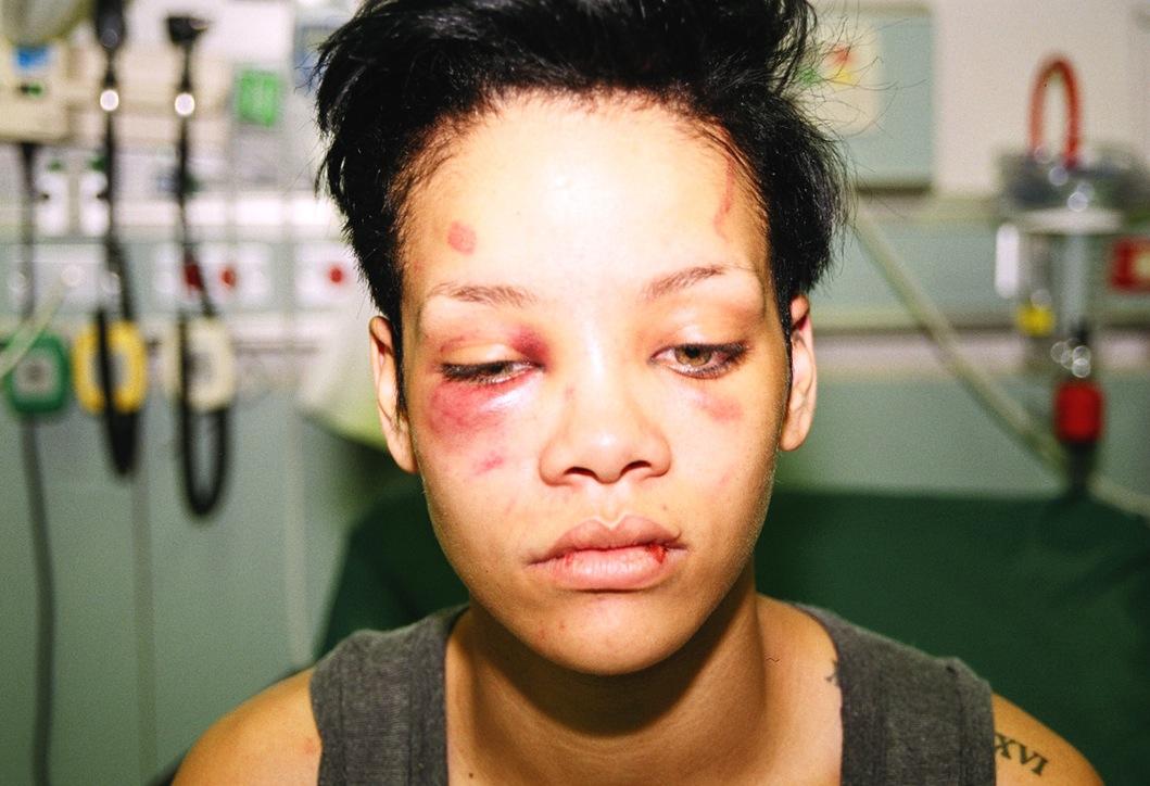 Rihanna’s face after Chris Brown attack