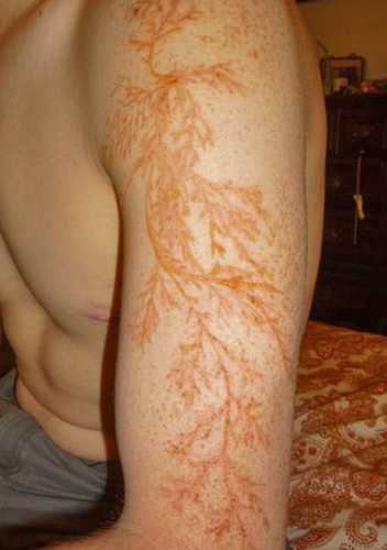 Being hit by lightning causes weird (and strangely beautiful) skin designs called "Lichtenberg figures."
