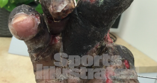 Jason Pierre-Paul Released Graphic Photos of His Hand Just After Firecracker Incident