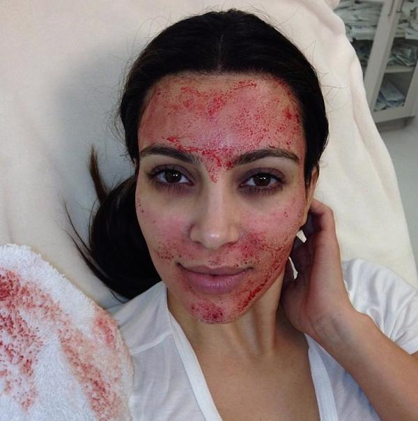 In 2013, Kim Kardashian tweeted a shot of her blood-spattered face after a gruesome $1,500 spa treatment that promises younger, firmer-looking skin.

The Vampire Facelift, trademarked by Alabama doctor Charles Runels, draws blood from the patient's arm and separates the platelets into a platelet-rich plasma (PRP) using a centrifuge. The plasma is then combined with Restylane or Juvederm and injected into the face to stimulate collagen production, and to remove fine lines and acne scars. The 45-minute facelift was such a hit in Hollywood that a gift certificate for the painful procedure was included in that year's Academy Awards gift bag.