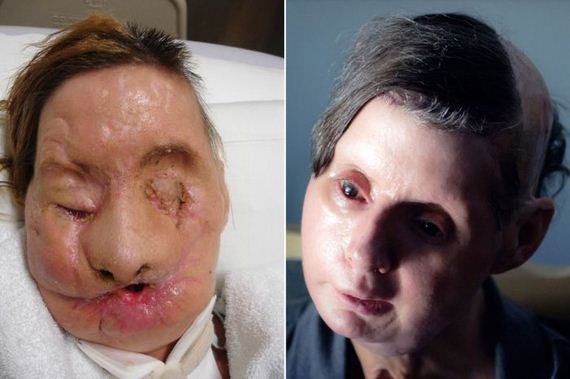 Eyes, nose, lips and jaws torn off by a chimpanzee on Xanax and after over five years of reconstructive surgeries, rehabilitation and painful recovery