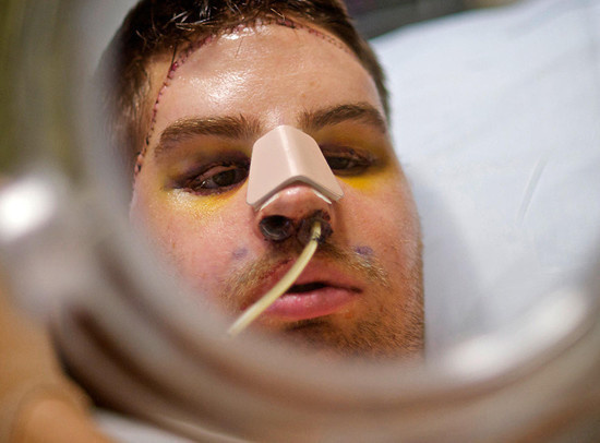 They also transplanted the muscles and nerve fibers necessary for him to move his face and feel sensation. In this photo, he sees himself for the first time after surgery.