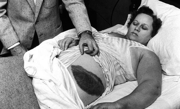 On November 30, 1954, a meteorite crashed through the roof of a home in a then-unincorporated area near Sylacauga, Alabama striking resident Ann Hodges. 

Hodges was napping on her living-room couch when the meteorite came through the ceiling smashing into her hip. When she saw the rock, she thought children were to blame, but geologist George Swindel, who was conducting fieldwork in the area, tentatively identified the object as a meteorite. 

Hodges became a minor celebrity over the next few weeks with offers to buy the meteorite pouring in from across the globe. Unfortunately, a three-way court battle involving Hodges, the USAF, and Birdie Guy, the owner of the rental house, ensued to determine ownership of the meteorite. Hodges eventually obtained the meteorite from Birdie Guy for the price of $500 (roughly $4,000 today), and it is now in the possession of the University of Alabama.