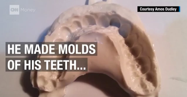 A college student aligned his teeth successfully by 3D printing his own clear braces for less than $60; he’d built his own 3D home printer but fixed his teeth over months with 12 trays he made on his college’s more precise 3D printer.