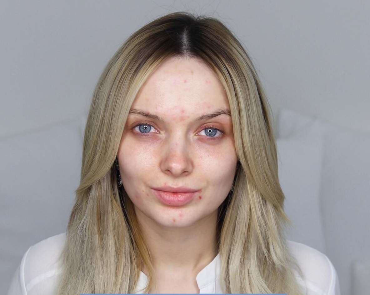 She hardly dealt with acne as a teenager. The Brit said the severe acne did not develop until March 2015. A lot of her tutorials are there to help that adult demographic that seems to be forgotten or unknown.