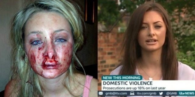 The following picture is disturbing to look at. Just 19 years old, Chantelle was brutally attacked by her boyfriend Rhys Culley. She was left with major scars and injuries.