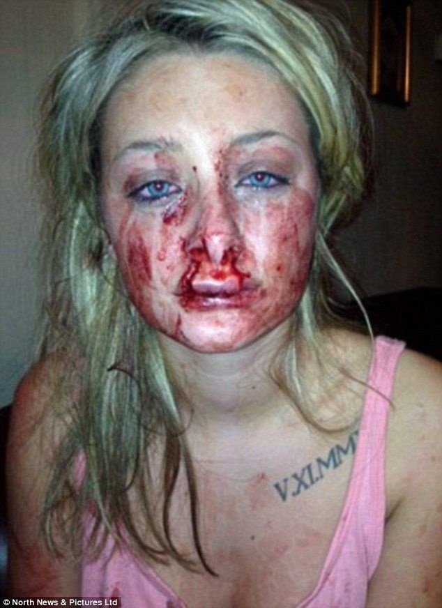 Her worst injury was on her upper lip. Culley bit through Chanttelle's upper lip completely, leaving her with an altered appearance. He was jailed for eight years for the attack.