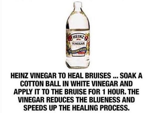 water - Heinz Vinegar Heinz Vinegar To Heal Bruises ... Soak A Cotton Ball In White Vinegar And Apply It To The Bruise For 1 Hour. The Vinegar Reduces The Blueness And Speeds Up The Healing Process.
