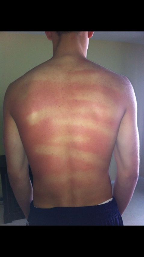 18 Painful Reminders That You Should Always Wear Sunscreen