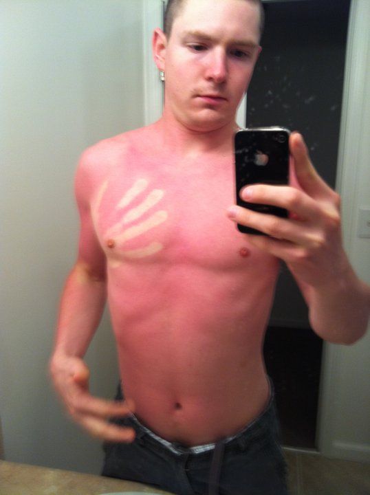 18 Painful Reminders That You Should Always Wear Sunscreen