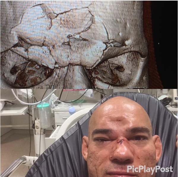 Picture of MMA Fighter, Cyborg Santos’ caved-in skull after being kneed by Michael Venom Page