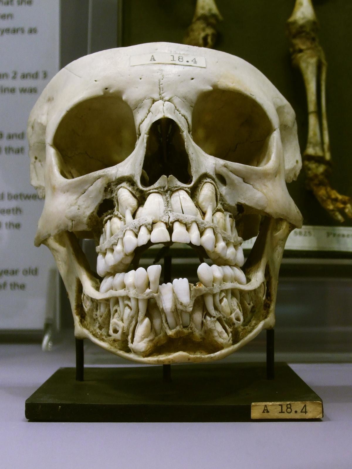 If you ever see the skull of a child, you will see teeth where you do not want teeth to be.