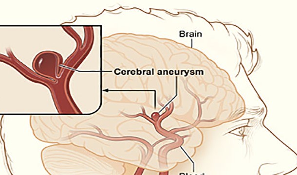 Aneurysms. Even the healthiest 20 year old can die in seconds due to an aneurysm. Be glad you woke up today.