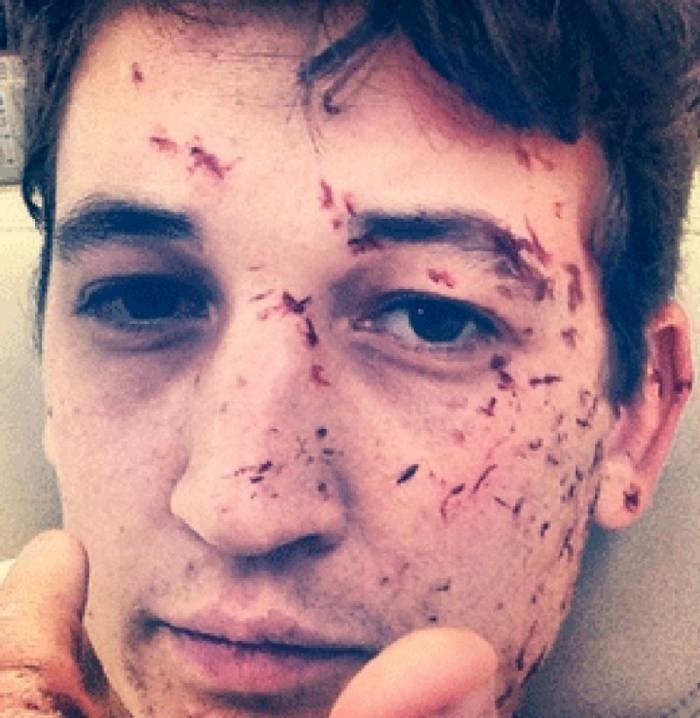 Miles Teller.

He was traveling from Connecticut to Florida, when suddenly the driver lost control of the vehicle. The car jumped three lanes of traffic and flipped eight times, before coming to a standstill. He was thrown from the car, and suffered a broken wrist, facial wounds, and got 20 staples in his shoulder.