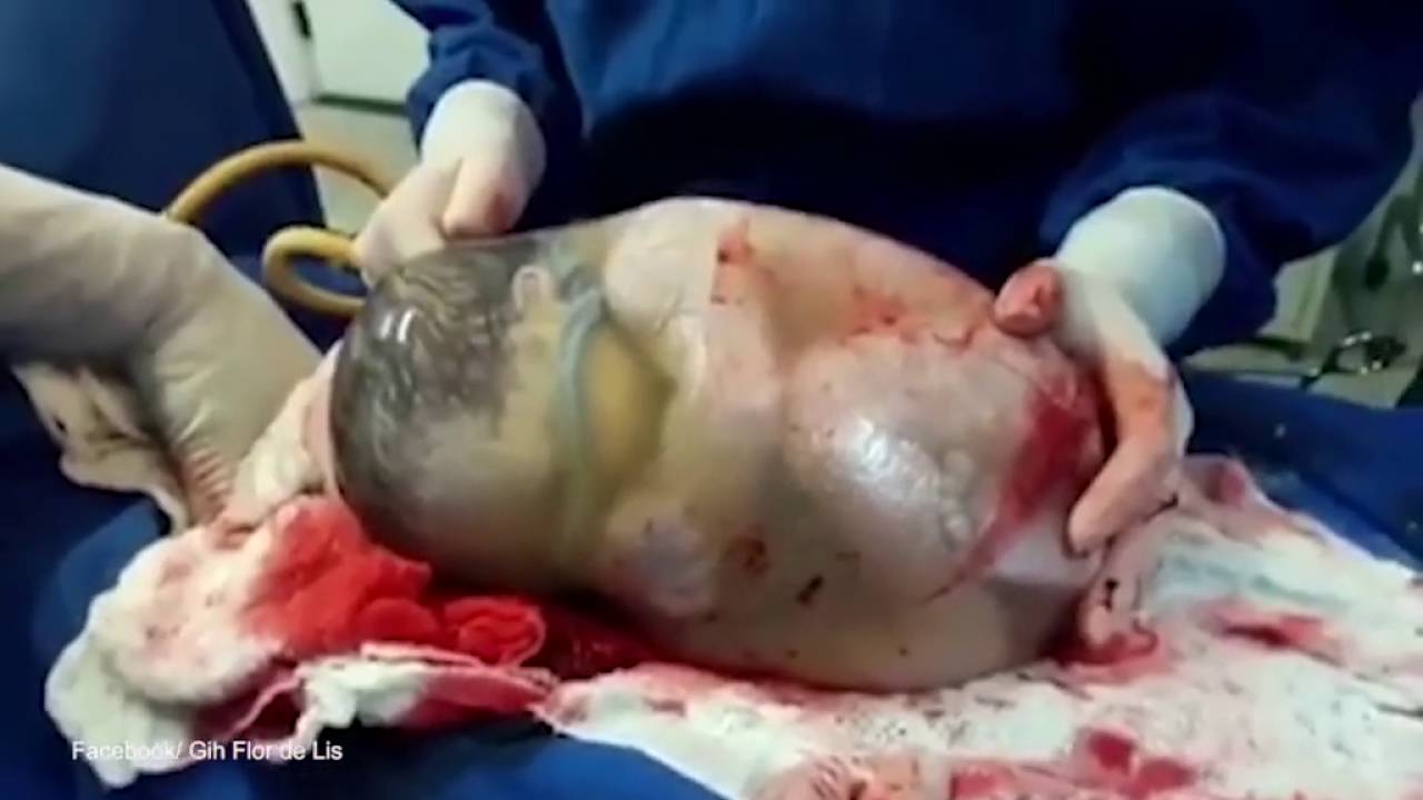 Baby Being Born Inside The Amniotic Sac