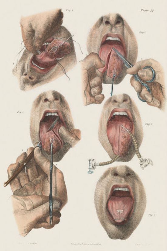 Patients suffering from cancer in the tongue had to have parts or all of it removed.
At the time, doctors only had this option to stop the spread of cancer. The surgery was so extreme and painful, patients chose to die from cancer rather than go through the procedure.