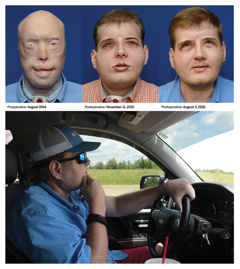 One year later, face transplant recipient just a normal guy.