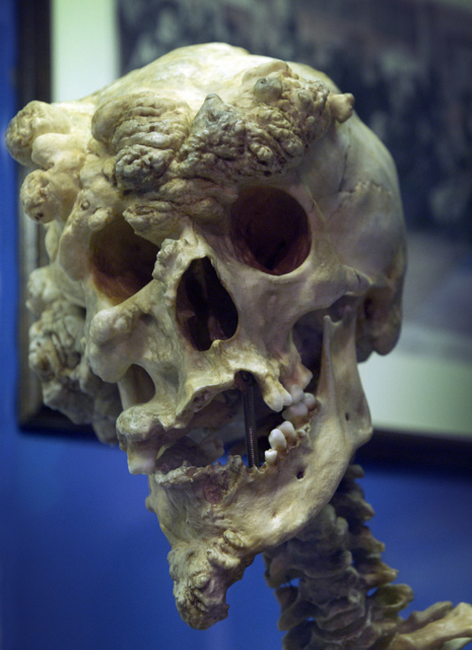 The skull of Joseph Merrick, often known as ‘the elephant man’.